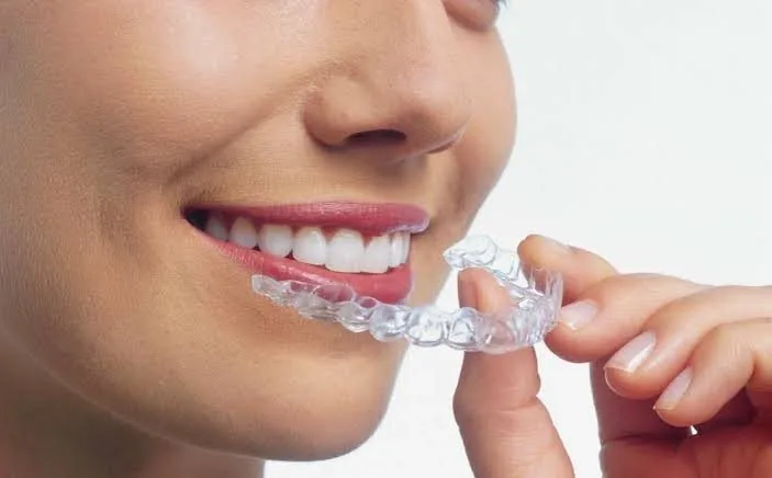 تقويم شفاف — ابتسامة صحية